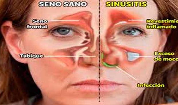 LA SINUSITIS QUÉ ES Y CÓMO ENFRENTARLA Diario Social RD