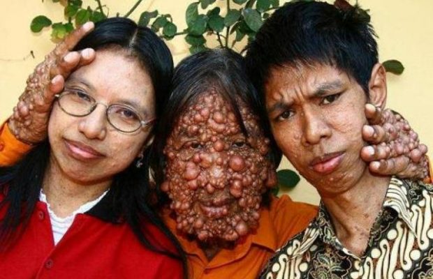 las enfermedades mas raras del mundo fotos las enfermedades mas raras del mundo fotos