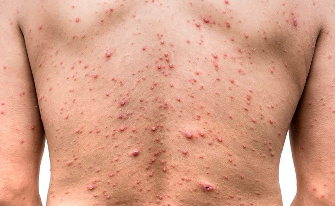 Casos emergentes de viruela del mono expertos recomiendan el uso del cubrebocas