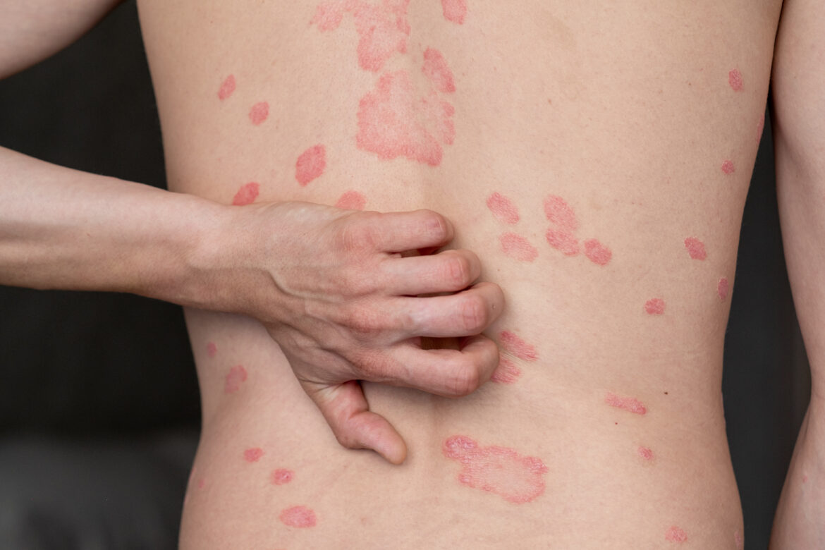 Psoriasis Vulgaris, skin patches are typically red, itchy, and scaly.