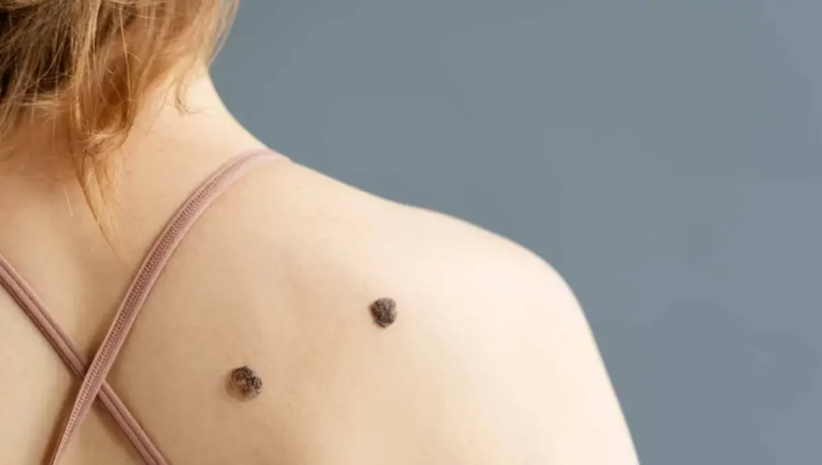 melanoma-caracteristicas